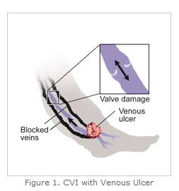 Center for Limb Preservation and Diabetic Foot - Chronic Venous  Insufficiency