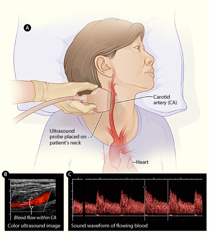 carotid_ultrasound